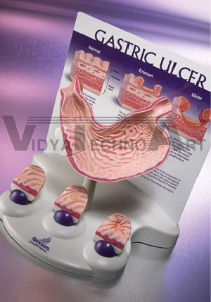 Gastric Ulcer Model